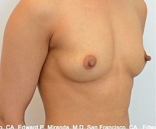 Breast Augmentation Before & After