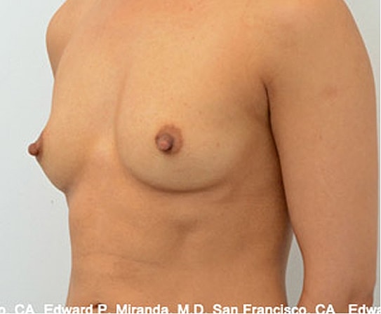 Breast Augmentation Before & After