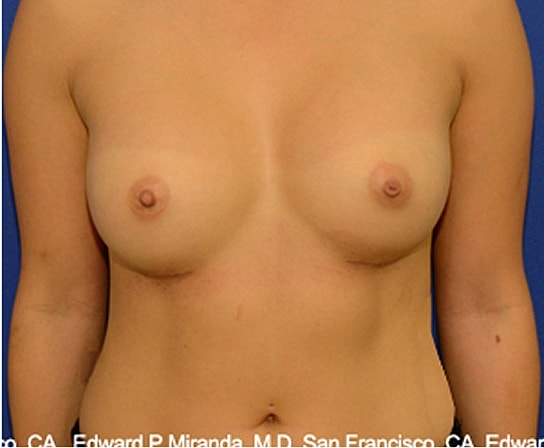 Breast Augmentation Before & After