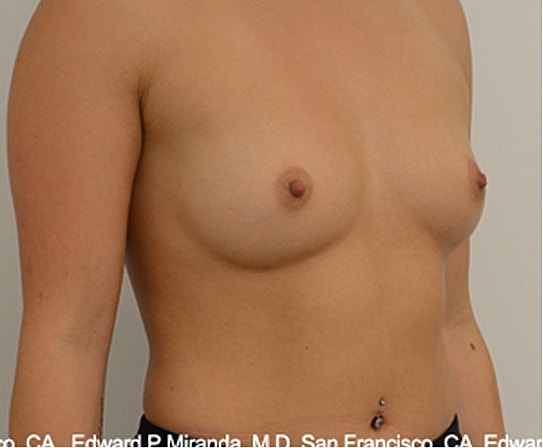 Breast Augmentation Before & After