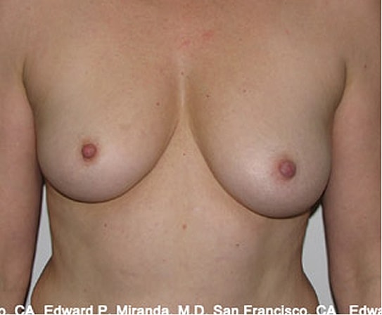 Breast Augmentation Before & After