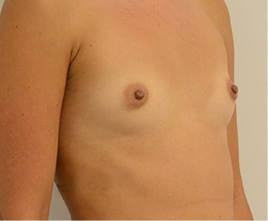 Breast Augmentation Before & After