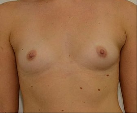 Breast Augmentation Before & After