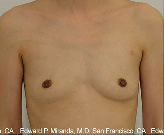 Breast Augmentation Before & After
