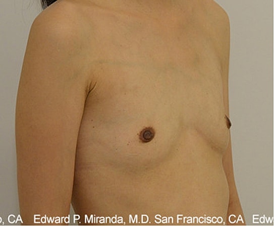 Breast Augmentation Before & After