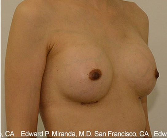 Breast Augmentation Before & After