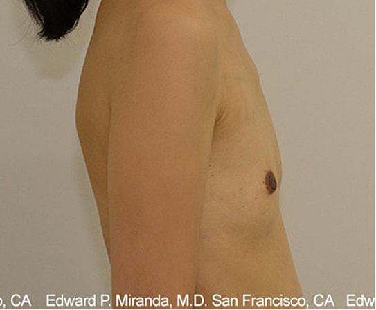 Breast Augmentation Before & After