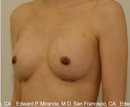 Breast Augmentation Before & After