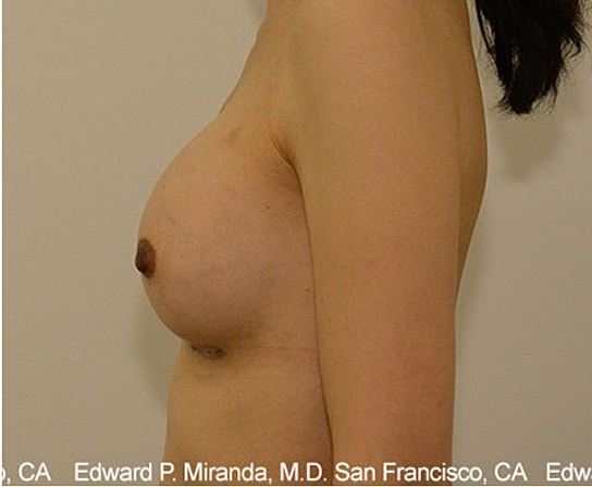Breast Augmentation Before & After