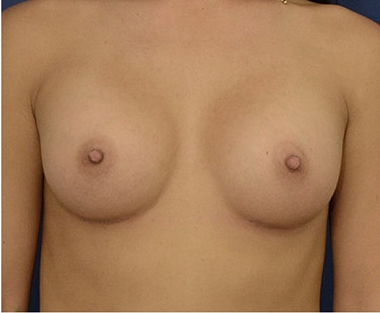 Breast Augmentation Before & After