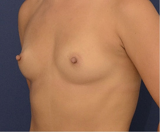 Breast Augmentation Before & After