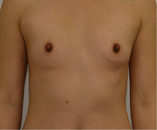 Breast Augmentation Before & After