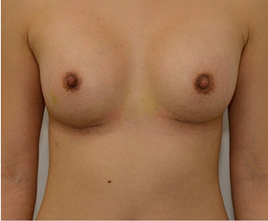 Breast Augmentation Before & After