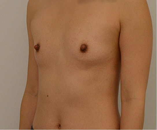 Breast Augmentation Before & After