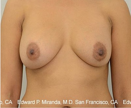 Breast Augmentation Before & After