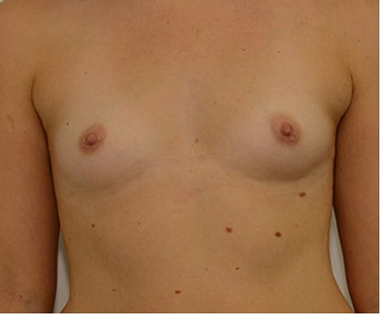Breast Augmentation Before & After