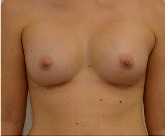 Breast Augmentation Before & After