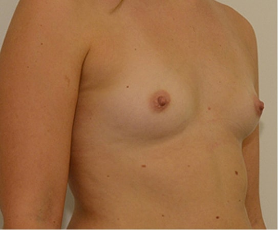 Breast Augmentation Before & After