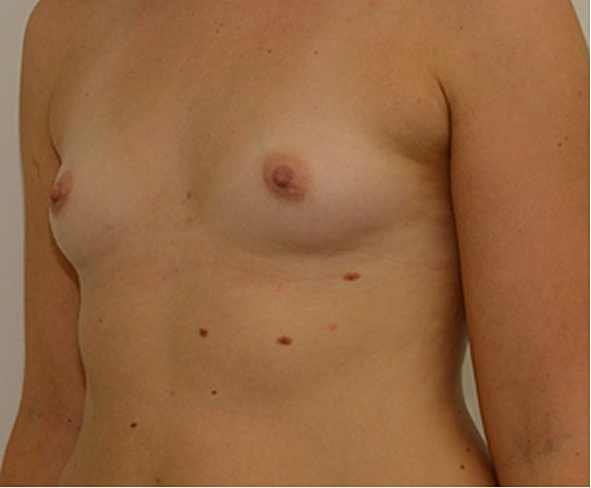 Breast Augmentation Before & After