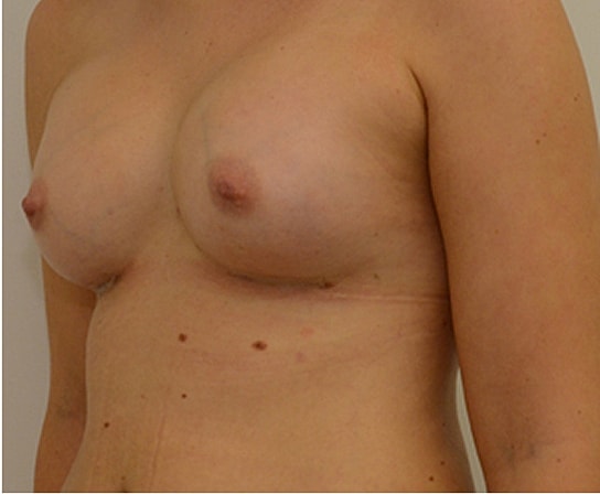 Breast Augmentation Before & After