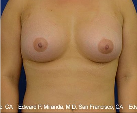 Breast Augmentation Before & After