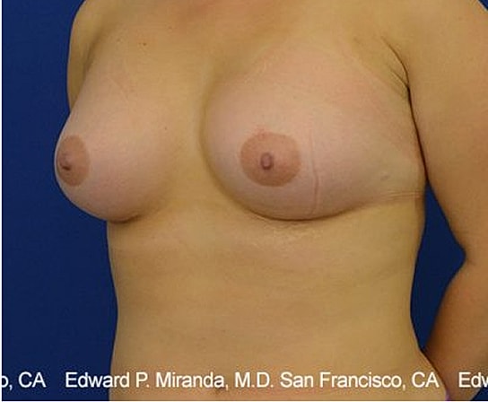 Breast Augmentation Before & After
