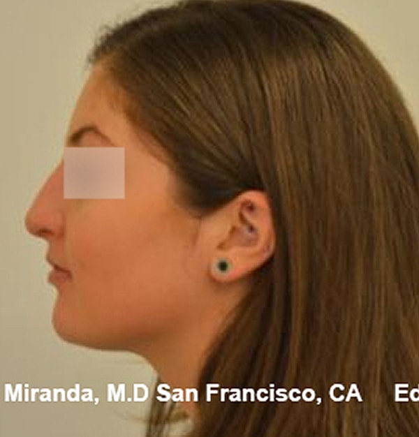 Rhinoplasty Before & After