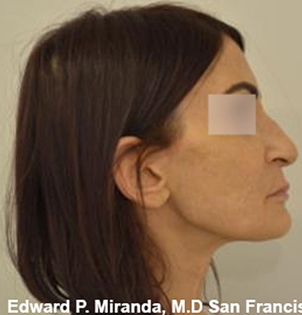 Rhinoplasty Before & After