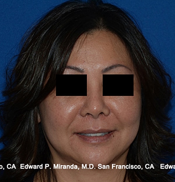 Rhinoplasty Before & After