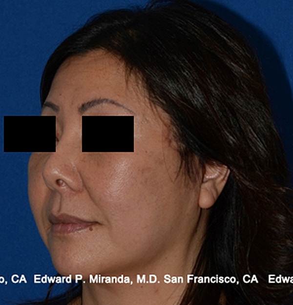 Rhinoplasty Before & After
