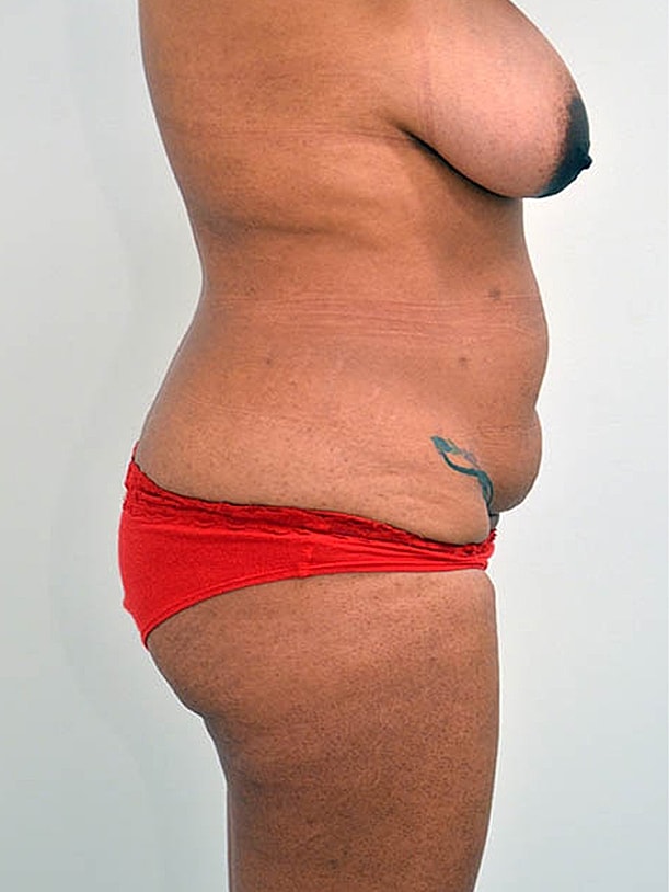 Tummy Tuck Before & After