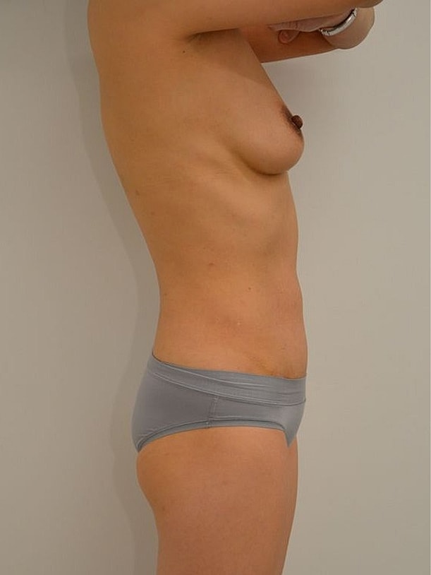 Tummy Tuck Before & After