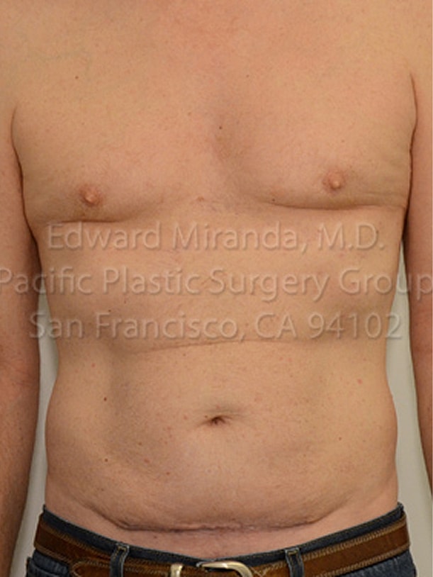 Tummy Tuck Before & After
