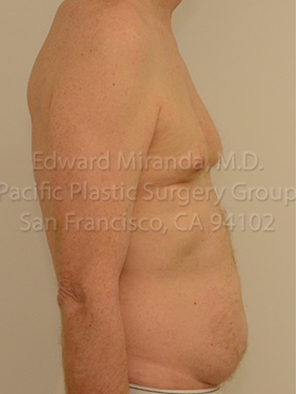 Tummy Tuck Before & After