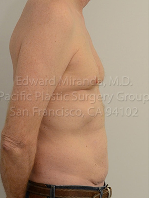 Tummy Tuck Before & After