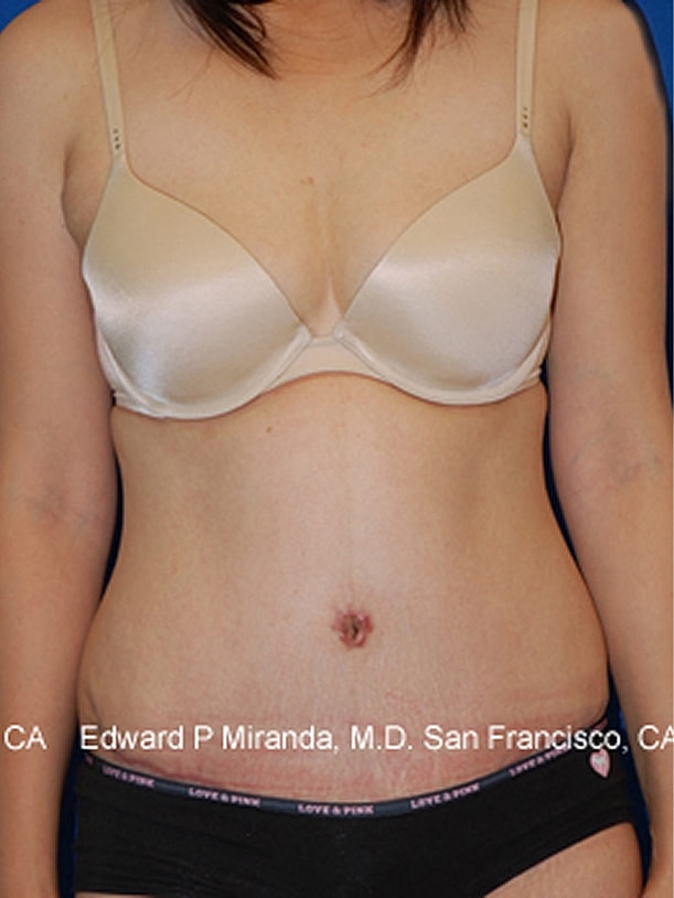 Tummy Tuck Before & After