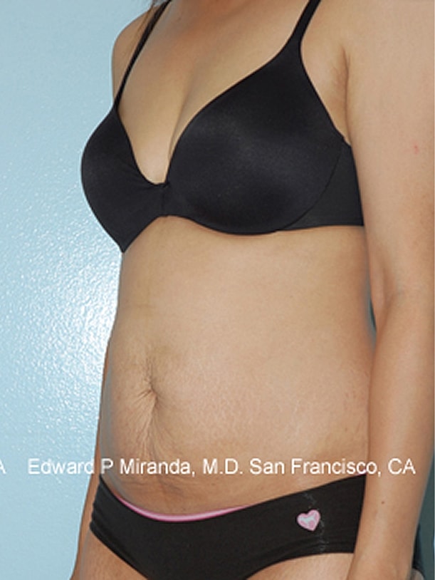 Tummy Tuck Before & After