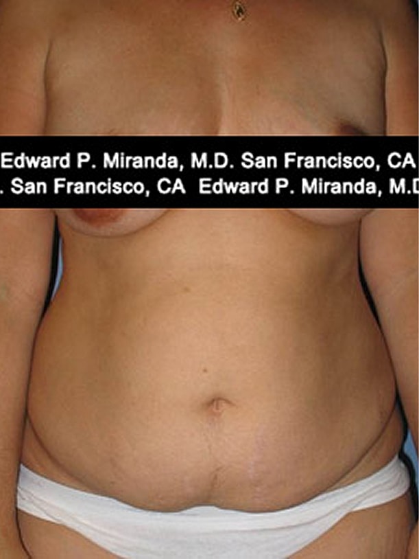 Tummy Tuck Before & After