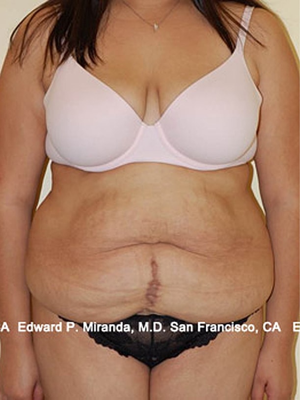 Tummy Tuck Before & After