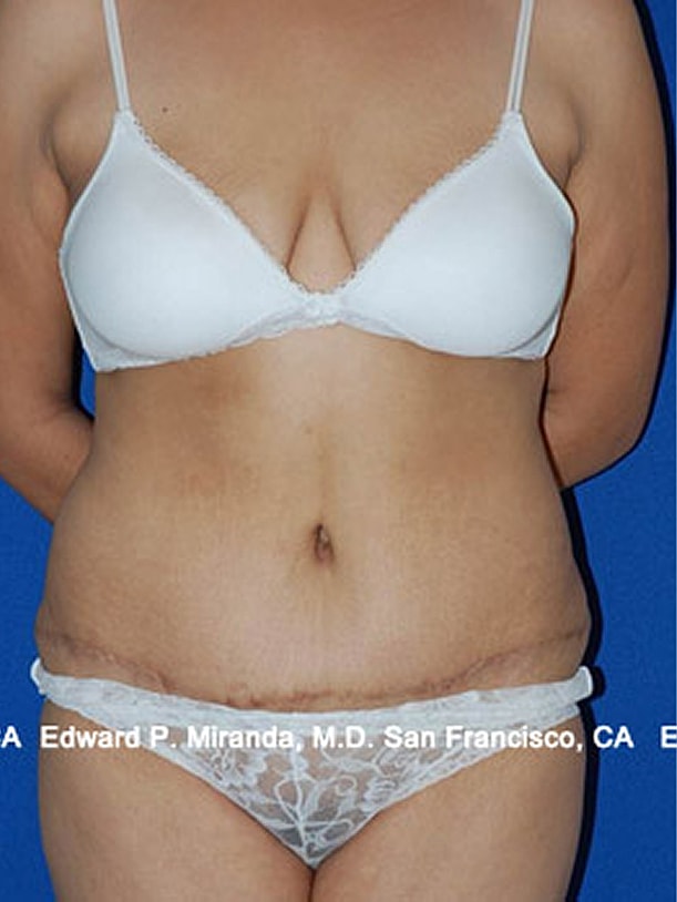 Tummy Tuck Before & After