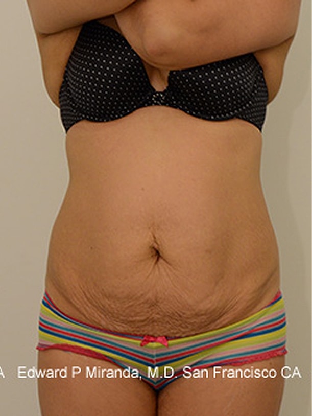 Tummy Tuck Before & After