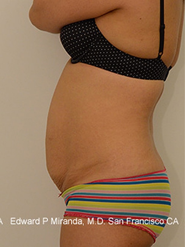 Tummy Tuck Before & After