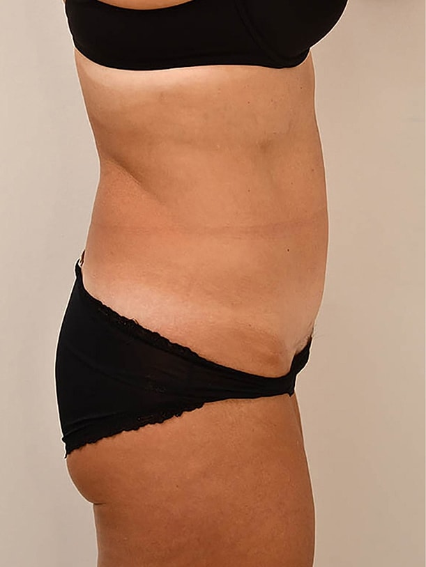Tummy Tuck Before & After