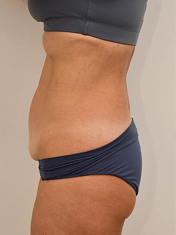 Tummy Tuck Before & After