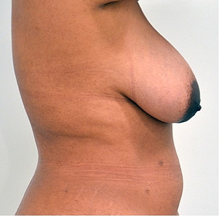 Breast Lift Before & After
