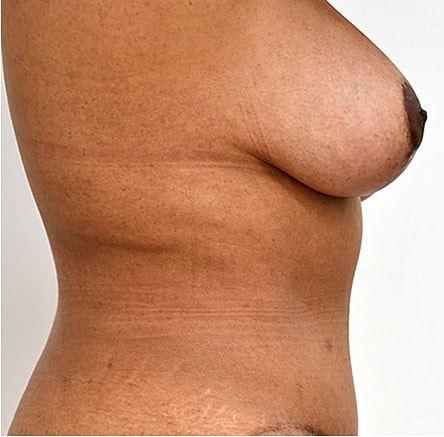 Breast Lift Before & After