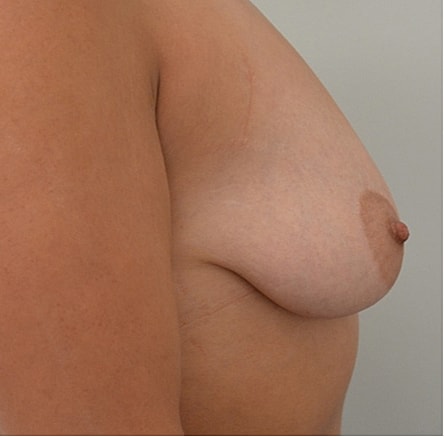 Breast Lift Before & After