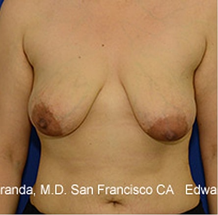 Breast Lift Before & After