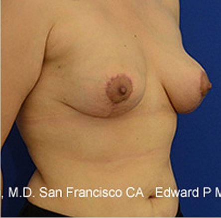 Breast Lift Before & After