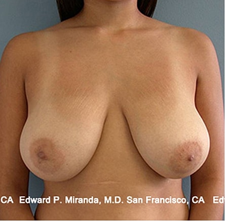 Breast Lift Before & After